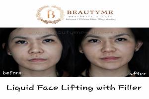Liquid Face Lifting With Filler
